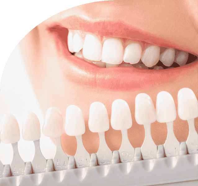 teeth whitening service annandchhaya