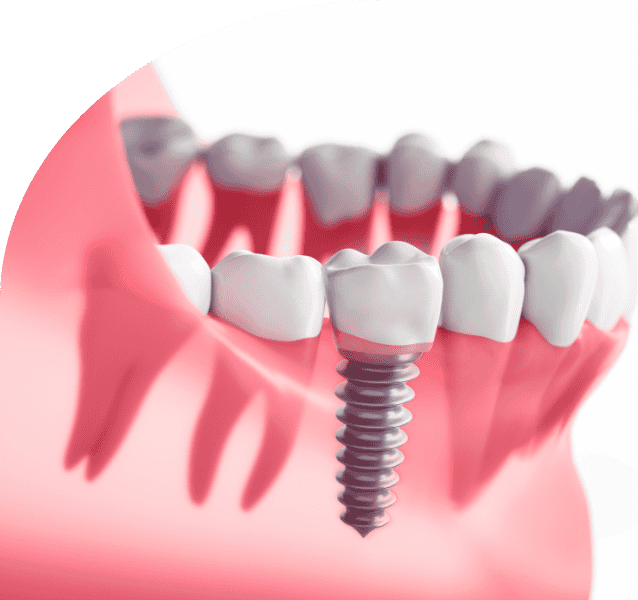 Dental Implants service annandchhaya
