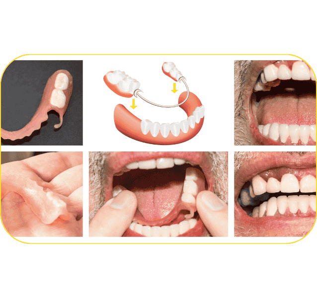 Full Mouth Rehabilitation service annandchhaya