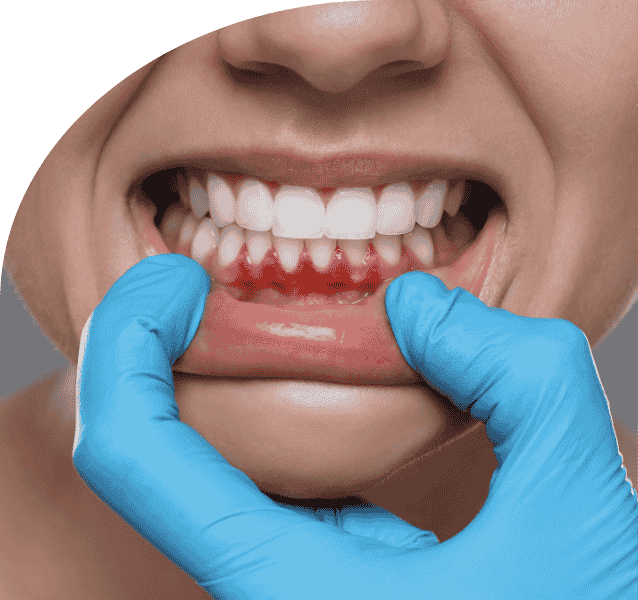 Gum Disease Treatment service annandchhaya